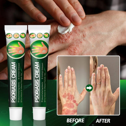 Psoriasis Cream (Original) – 20g